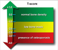 t-score-botdensitometrie